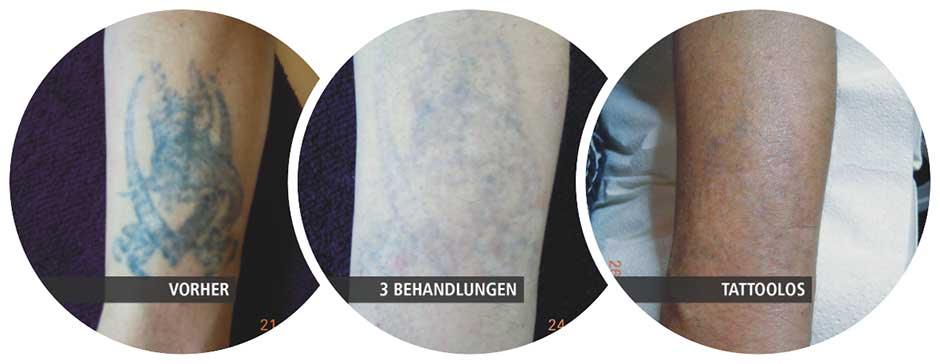 Vorher-Nachher-Bild: Tattooentfernung von einem Tattoo am Unterarm