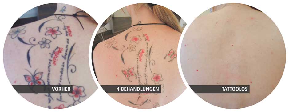 Vorher-Nachher-Bild: Tattooentfernung von einem Tattoo am Rücken