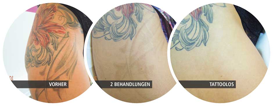 Vorher-Nachher-Bild: Tattooentfernung von einem Tattoo am Oberschenkel