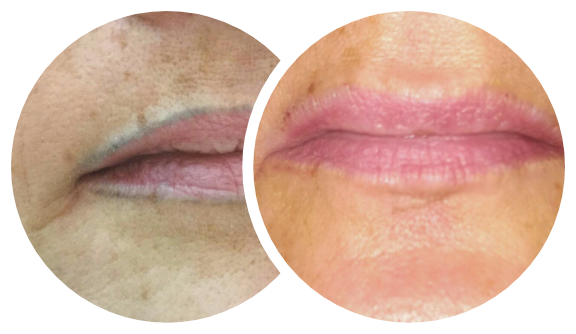 Vorher-Nachher-Bild von einer Permanent Make-up Entfernung der Lippenkontur