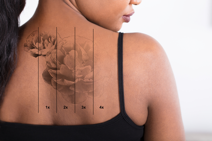 Symbolbild Tattooentfernung Düsseldorf: Frau mit tätowierter Blume auf dem Rücken. Es sind vier Stufen der Laserbehandlung zu sehen, mit einem nach und nach verblassenden Tattoo.